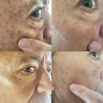 ✨Gyors Sötét Folteltávolító - AQA™ Melanin Korrekciós Arcszérum (🔥Utolsó Napi Akció 60% KEDVEZMÉNY)