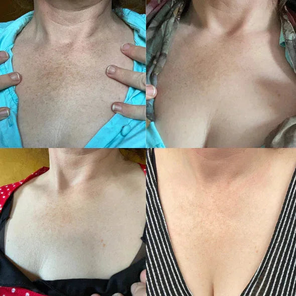 ✨Gyors Sötét Folteltávolító - AQA™ Melanin Korrekciós Arcszérum (🔥Utolsó Napi Akció 60% KEDVEZMÉNY)